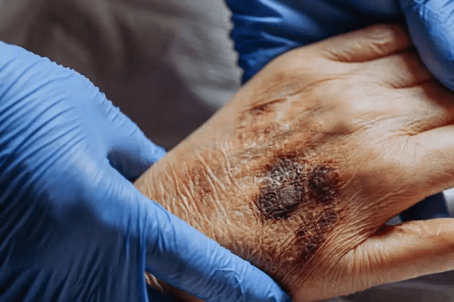 What should I do If I Suspect Nursing Home Abuse and Neglect? - Michael Hill