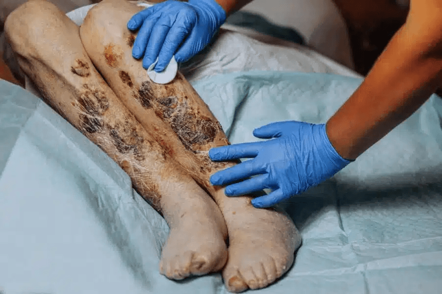 Bedsores in Nursing Homes: A Preventable Sign of Neglect