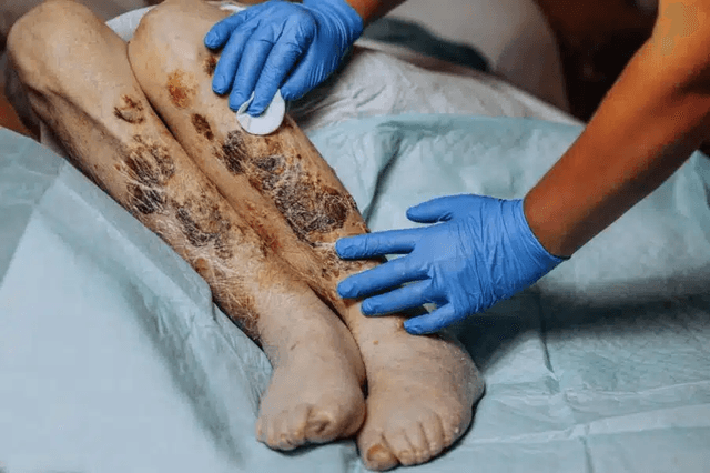 Bedsores in Nursing Homes: A Preventable Sign of Neglect